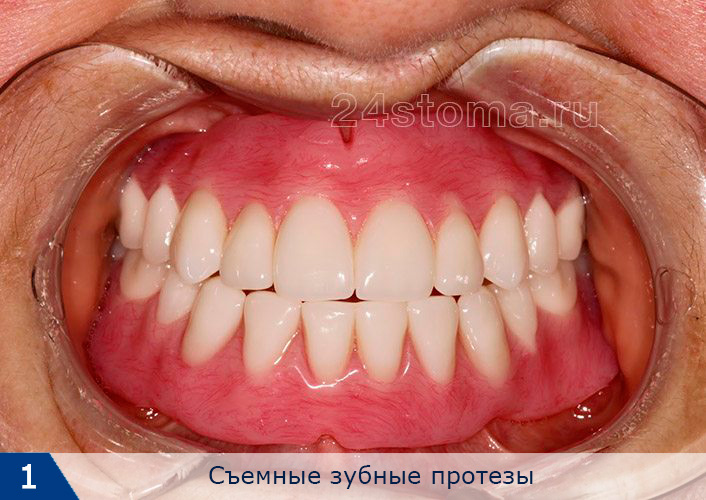 Полные съемные зубные протезы на верхнюю и нижнюю челюсть, изготовленные из акриловой пластмассы